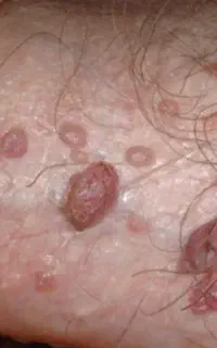رفع قطعی و ریشه ای زگیل و تبخال