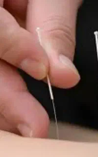 آموزش طب سوزنی در اصفهان/ تضمینی / مدرک بین الملی