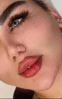 ژل، فیلر، بوتاکس، فیلر بادی، آنزیم