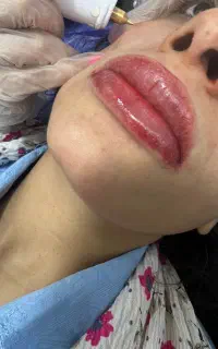 دکوپاژ لب و چال لپ