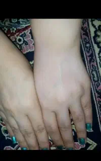 از شر خال هات خلاص شو