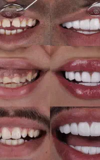 کامپوزیت/لمینت/دندانپزشکی