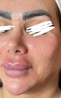 فیشال پوست