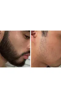 محصول رویش ریش و مو