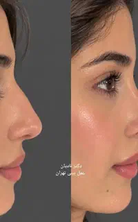 عمل بینی در تهران