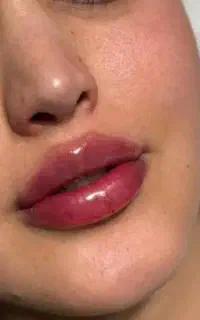 فیلرژل لب بوتاکس فیلر مادلینگ لیزرموهای زائدفشیال
