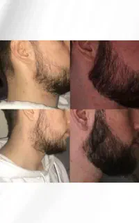 خداحافظی با کم پشتی ریش