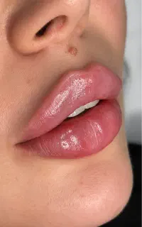 فیلر لب توسط دکتر متخصص زیبایی