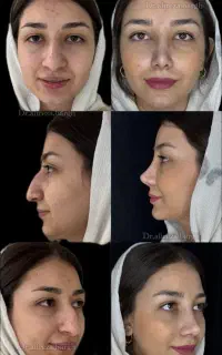 عمل جراحی بینی جشنواره پاییزه 35