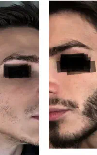 قبل از استفاده از ماینوکسیدیل اینو ببین