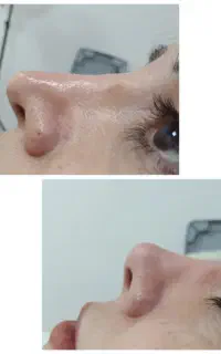 لیفت تخصصی صورت،پلک وابرو،بینی بروش نخ