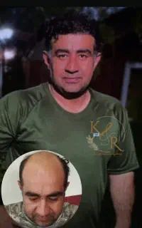 کاشت مو با تضمین تراکم