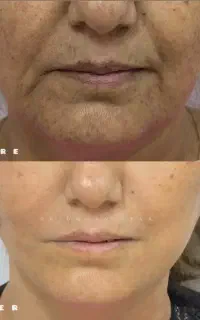 جراحی لیفت مینیمال صورت بدون بیهوشی