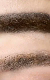 ریموو تاتو ابزو با لیزر 1.000.000 تومان