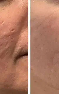 حذف جای زخم/رد بخیه/آکنه/همرا با پی آرپی رایگان