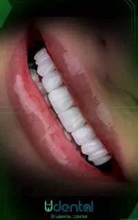 کامپوزیت لمینت ایمپلنت اقساط ویژه