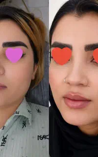 خدمات ژل و بوتاکس با تضمین کیفیت ،اصالت و قیمت