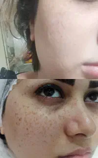 ریموو کک ومک در یک جلسه ودرمان صد درصدی لک ملاسما