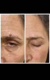 برداشت خال های گوشتی برجسته