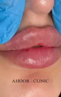 بوتاکس رایگان توسط پزشک فیلر  ژل جوانساز و...