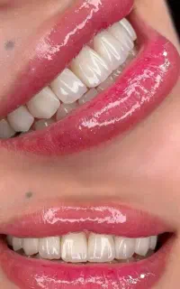 ورکشاپ آپدیت و اموزش تکنیک لیر (لبه شفاف) کامپوزیت