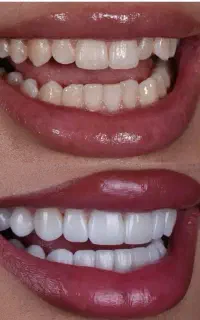 کامپوزیت. عصب کشی. روکش