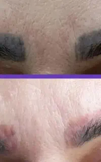 تخفیف ویژه پاک کردن تتو  سفید کردن تیرگی منظریه