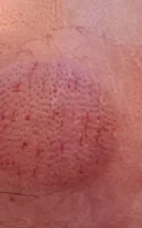 حجامت و بادکش درمانی و خدمات پرستاری تحت نظره پزشک