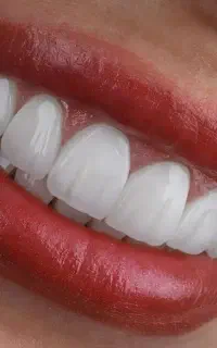 دندان پزشکی ترمیم عصبکشی ‌ارتودنسی لمینت ایمپلنت