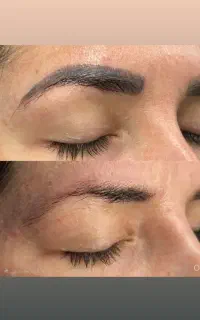 پاک کردن تتو و خالکوبی با دستگاه لیزر(تخفیف ویژه)