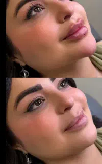 آف ویژه خدمات ژل ۷۵۰ و بوتاکس ۹۰۰در مطب