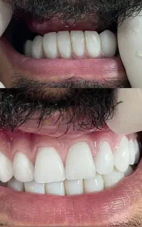 ساخت دندان مصنوعی به روش bps