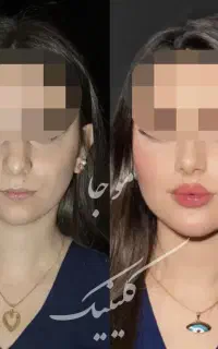 فیلر،ژل،بوتاکس،پی آرپی،مزوتراپی درکلینیک توسط پزشک