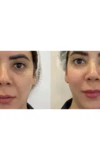 فشیال پاکسازی پوست حدف کک مک پلاژن هایفوتراپی وRF