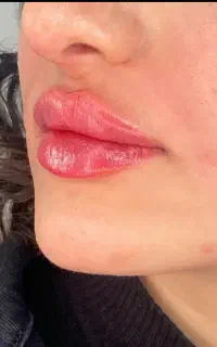ژل و بوتاکس کاملا نچرال و طبیعی تضمینی