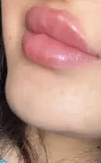 تزریق اصولی فیلر با حضور پزشک در مطب ۱/۲۰۰