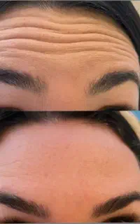 آموزش و تزریق ژل فول فیس و بوتاکس و مزوتراپی