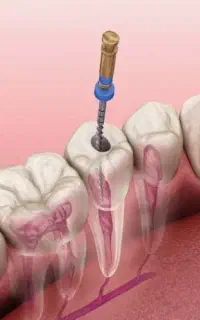 عصب کشی و درمان و خدمات مختلف با طرح