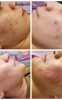 آموزش تخصصی  فیشال و پاکسازی