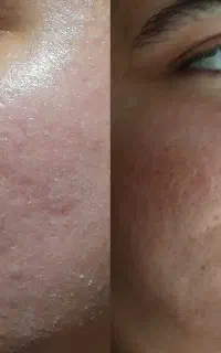 لکبرداری صورت بانوان