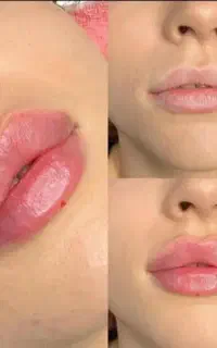 ژل (فیلر)بوتاکس