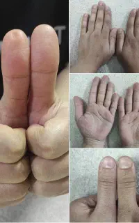 تدریس طب سنتی کف شناسی(کف بینی)