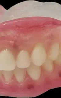 دندون سازی ۲۰درصد تخفیف