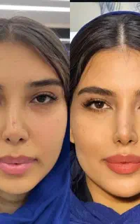 تزریق فیلر، بوتاکس، مادلینگ زیر نظر متخصص