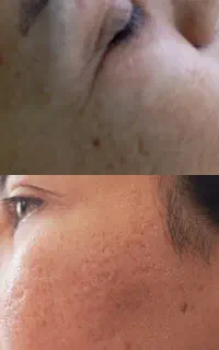 پاکسازی و فیشال تخصصی