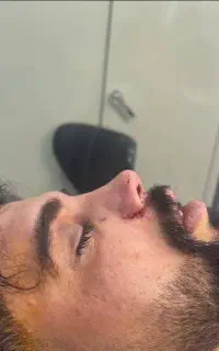 عمل بینی ساکشن غبغب ژل بوتاکس