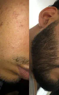 راهکار کم‌پشتی ریش