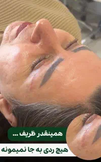 بلفارو پلاستی و کاشت ابرو قسطی