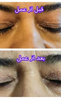 زیبائی پلک بالا و پائین