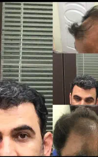 کاشت مو ابرو ریش کلینیک تخصصی اکسیر اقساط